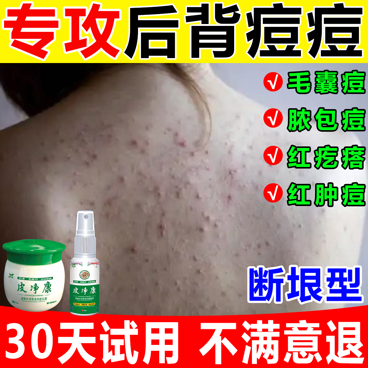 后背毛囊痘痘背上胸前脖子头皮去除止痒专用软膏皮肤抑菌喷剂神器