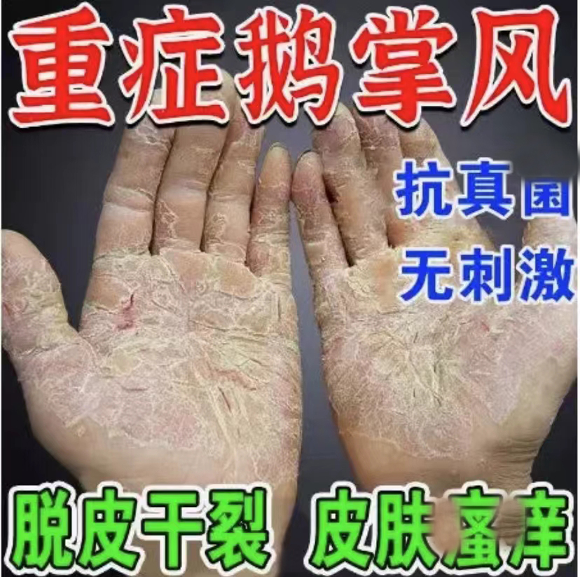 鹅掌风手足裂口脱皮发痒手上干裂脱皮真菌感染止痒草本抑菌软膏