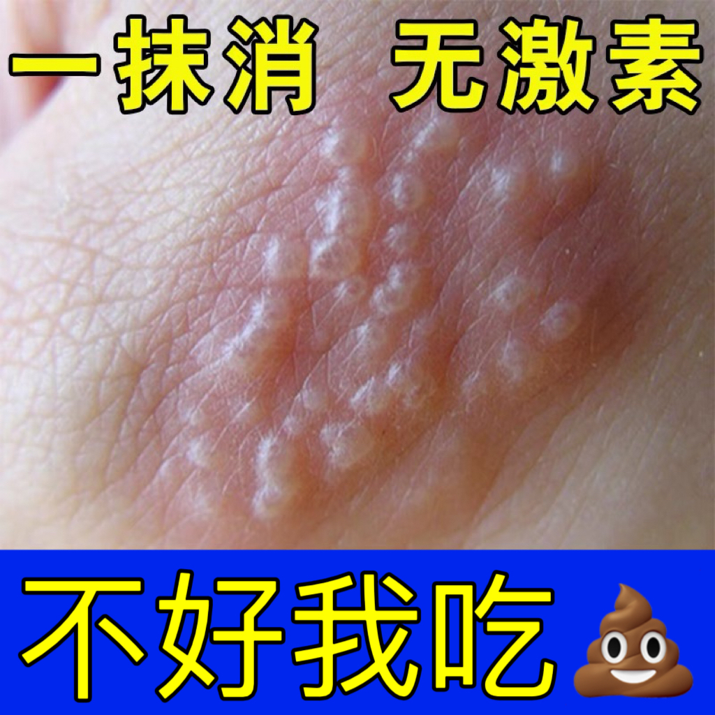 手上痒长小疙瘩起水泡干痒日光性红肿痒的抓出血止痒抑菌专用软膏