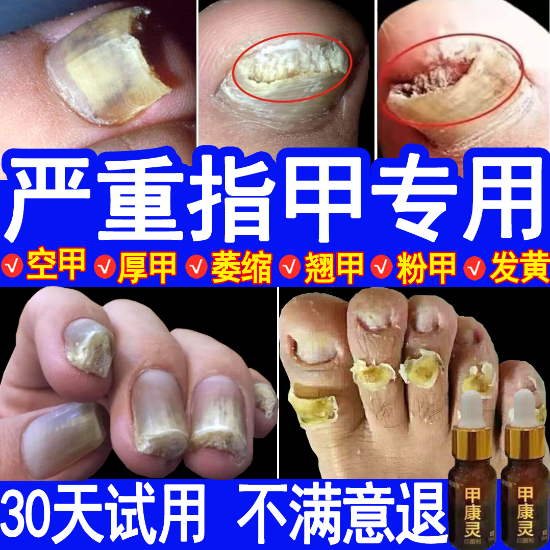 手指趾甲专用抑菌液亮甲发灰增厚发黄脚指甲根专用特效正治品克星