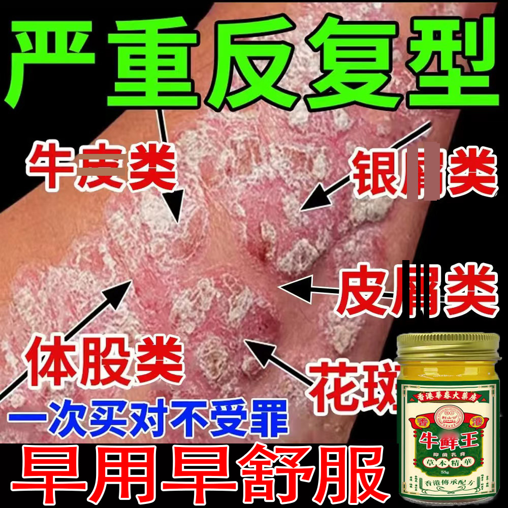 【牛藓王】牛痒皮肤顽固性手足反复红点全身用止痒膏大腿内侧止痒膏