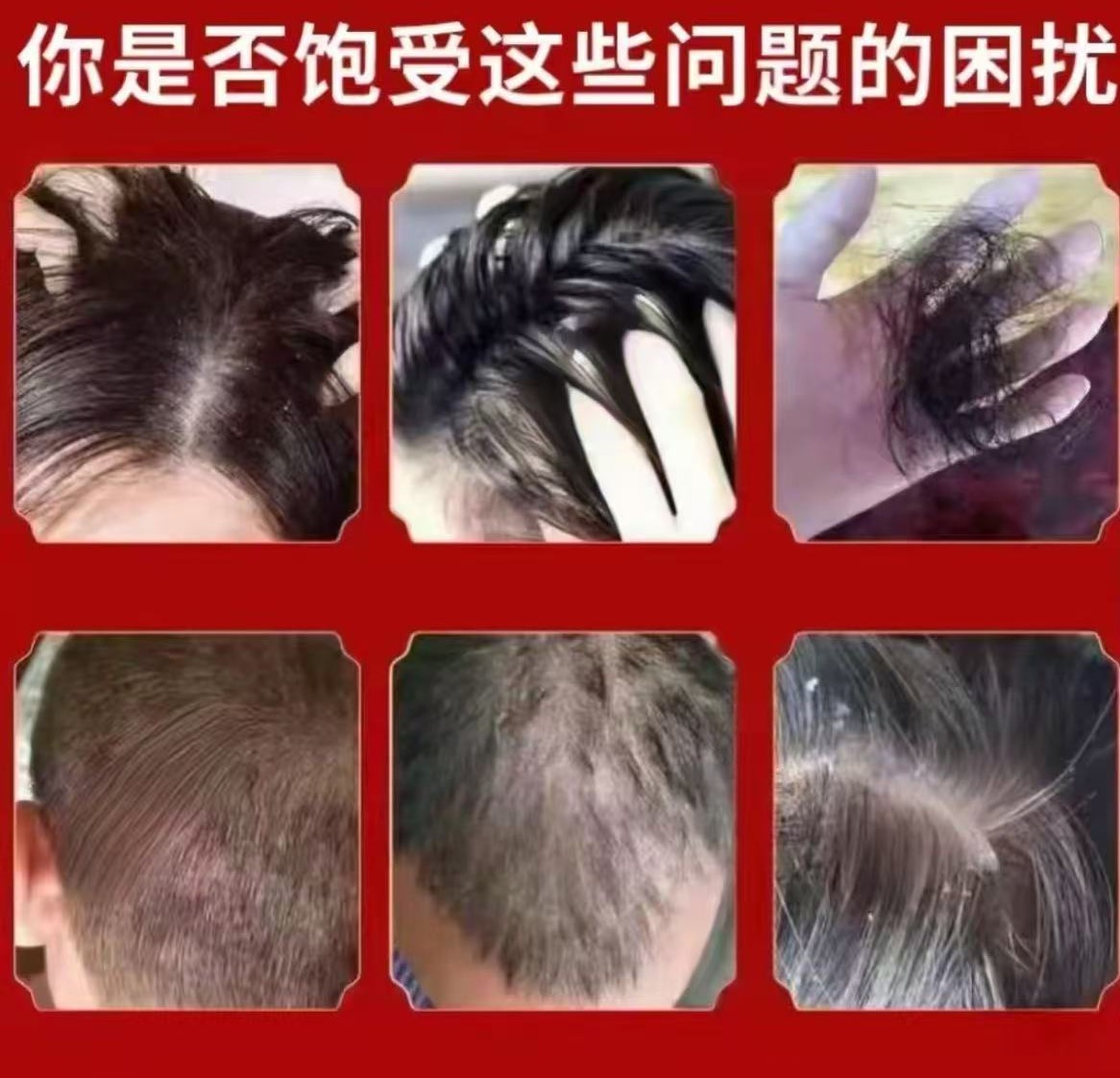 头皮头痒头上长小红疙瘩头上长痘痘起干皮头上毛囊严深层抑菌膏