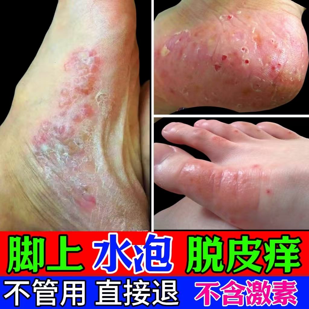  脚底脚上起小水臭痒泡脱皮真菌王脚臭止痒抑菌软膏喷雾剂