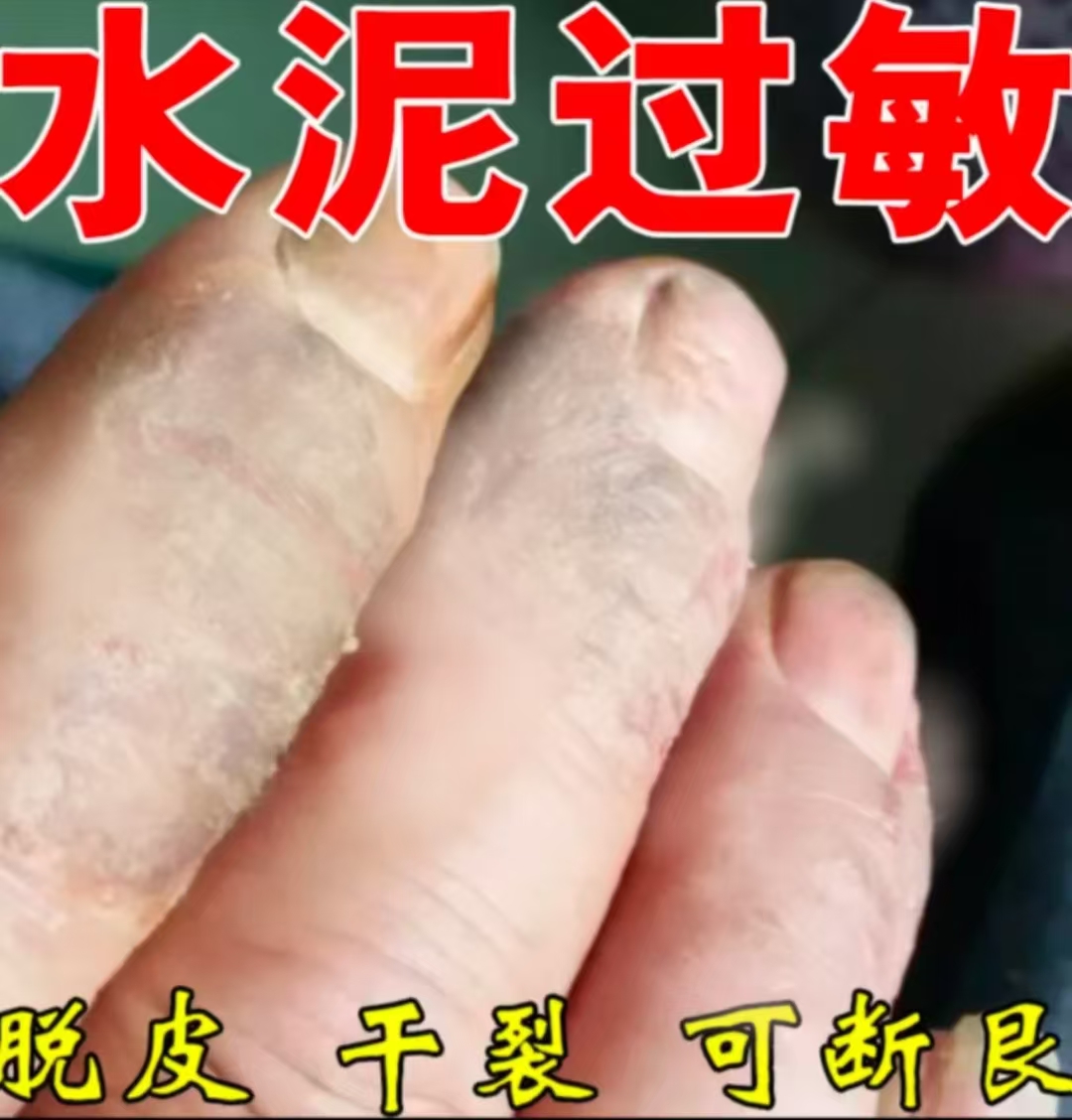 祛水泥过迷敏手指干裂痒起小水泡皮肤外用草本