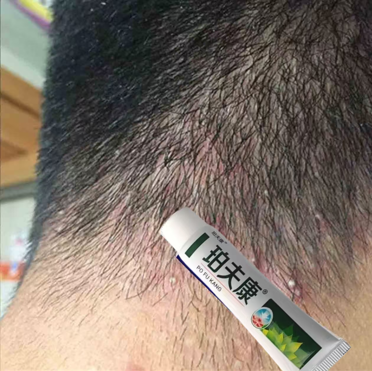 头皮毛囊头上长小红疙瘩脓包头屑痘痘头部专用止痒克星治疗外用膏