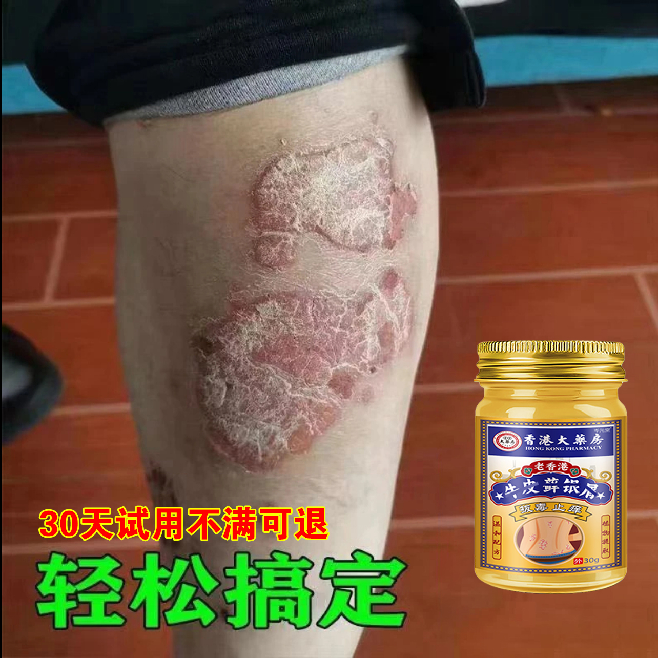 【牛皮藓】全身白屑皮肤止痒红点顽固手足体股香港大楽房草本乳膏