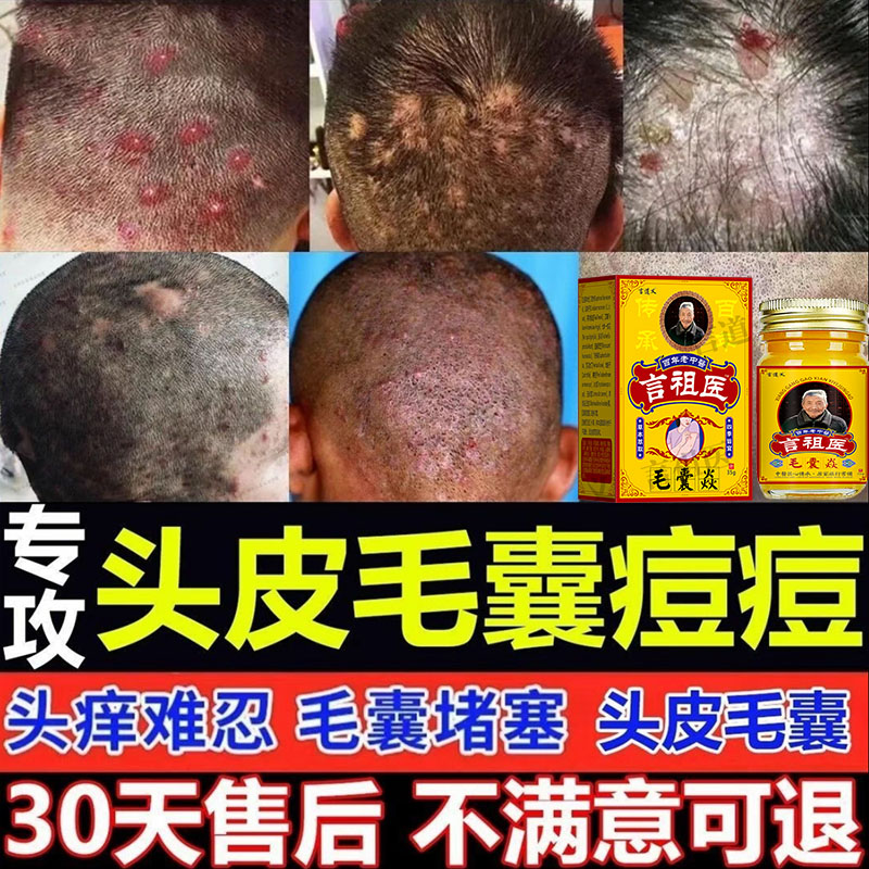 言道义毛囊膏马拉色菌前胸后背头皮毛囊小疙瘩红点红痘痘草本抑菌