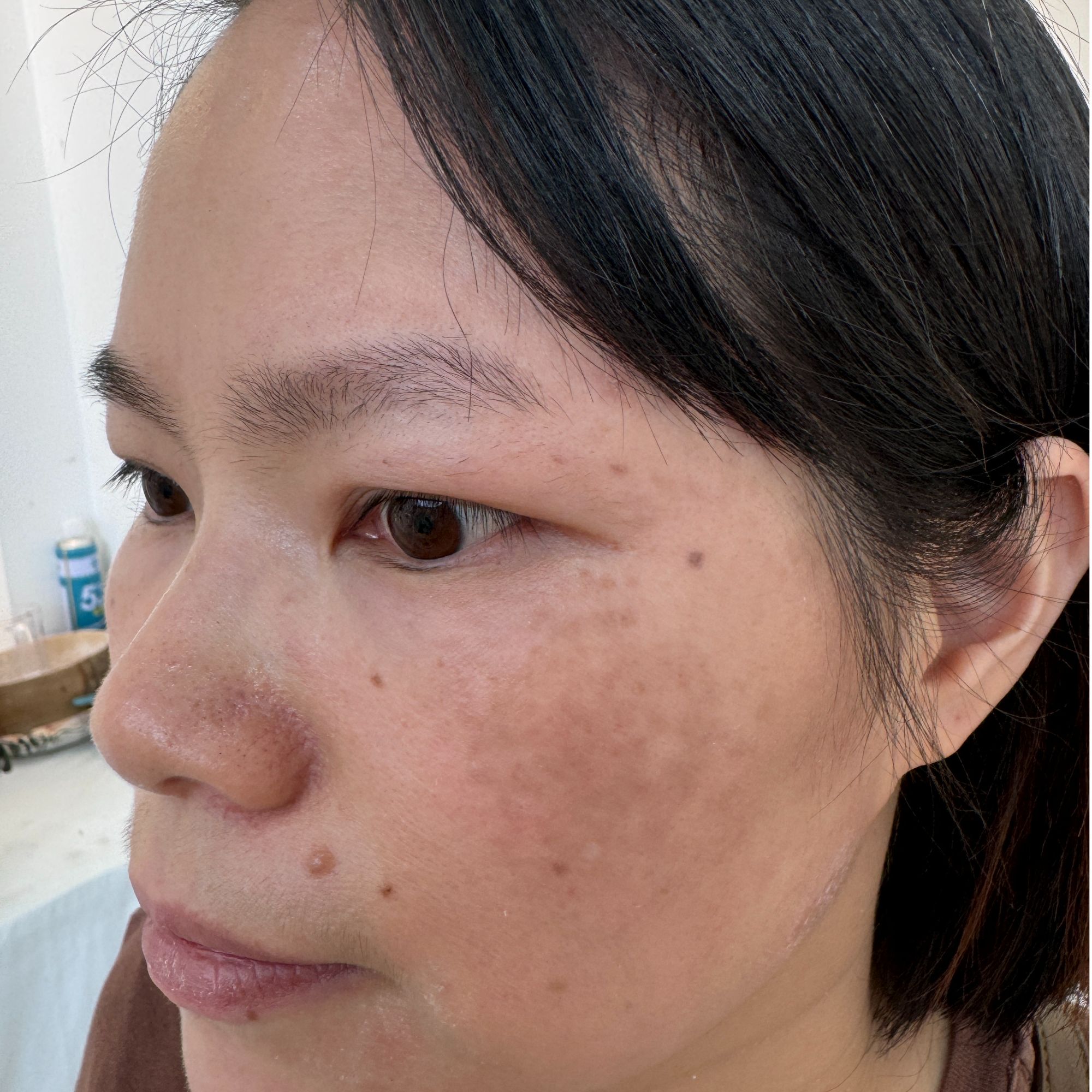 全脸干净祛斑祛痘