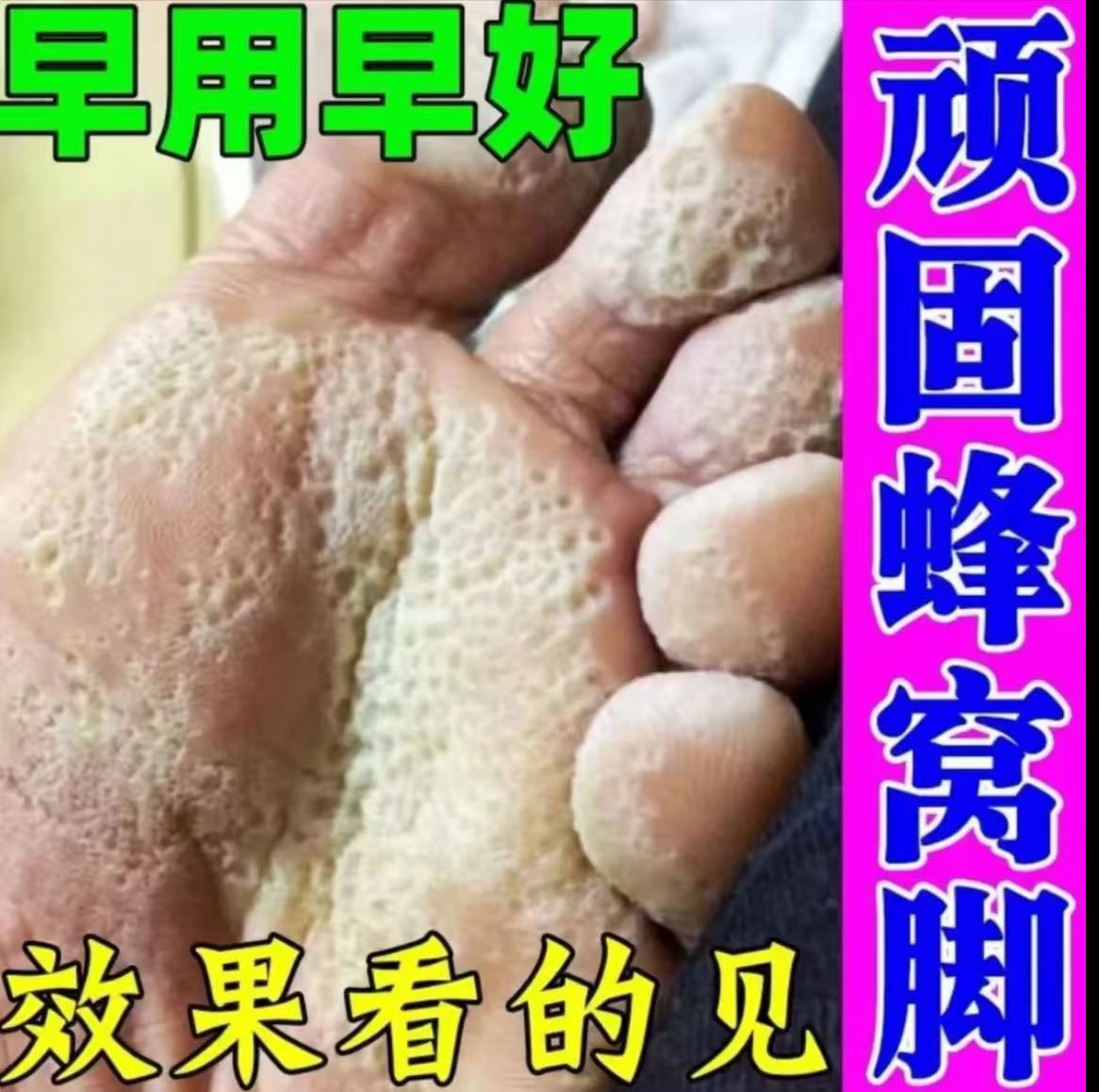 严重脚脱皮脚底板脱皮脚心痒脚痒起水泡起皮脚后跟干燥起皮裂口