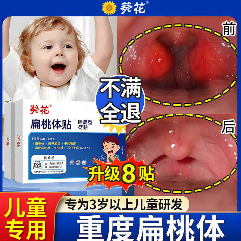 葵花儿童扁桃体腺样体肥大肿大贴面容矫正器嗓子发焱肿痛打呼噜贴