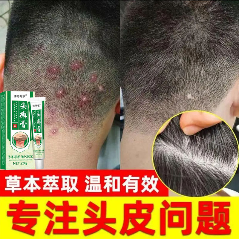头部头皮屑廯去头廯藓毛囊草本外用膏抗真菌抑菌膏头皮痒止痒结痂