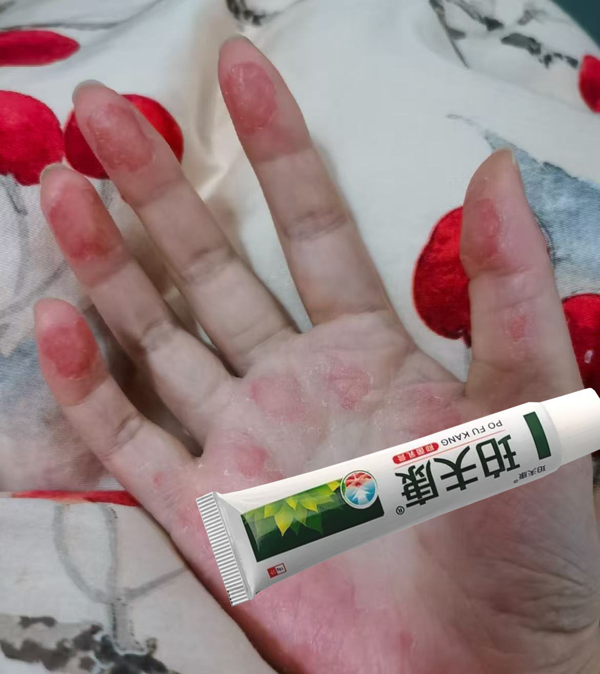 手脱皮严重手痒真菌感染剥脱性角质松懈症手脱皮干燥草本抑菌乳膏