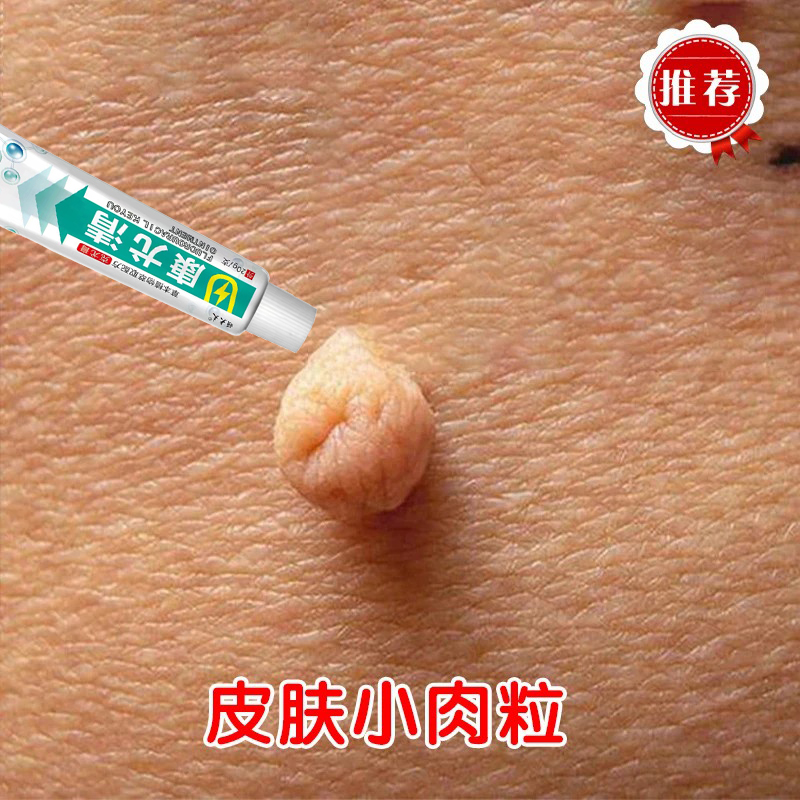 皮肤凸起硬肉刺扁平手足寻常疙瘩脖子腋下肉粒丝状肉钉温和膏q