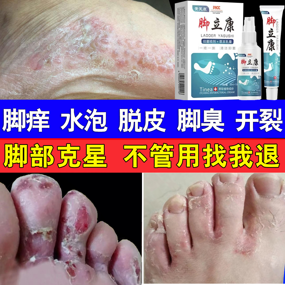 脚趾缝臭痒专用抑菌止痒膏脚痒干裂脱皮汗脚克星水泡喷雾剂正品
