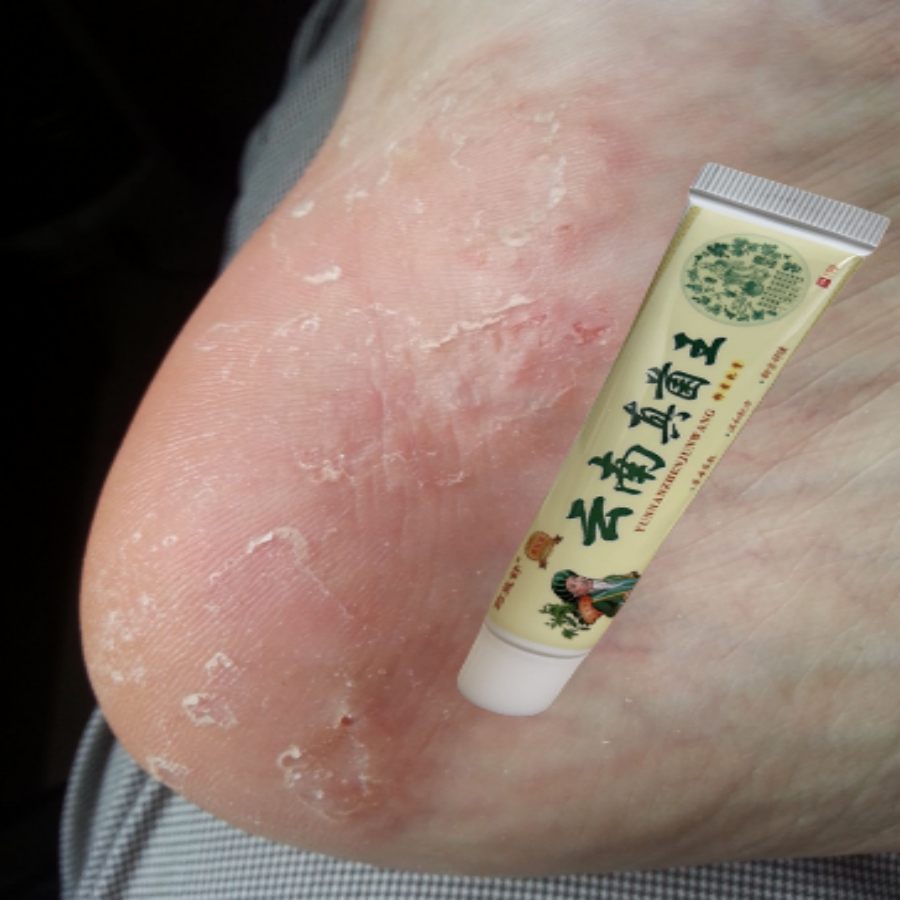 【云南真菌王】手足皲裂脱皮膏脚后跟干裂舒缓霜干燥粗糙护足霜