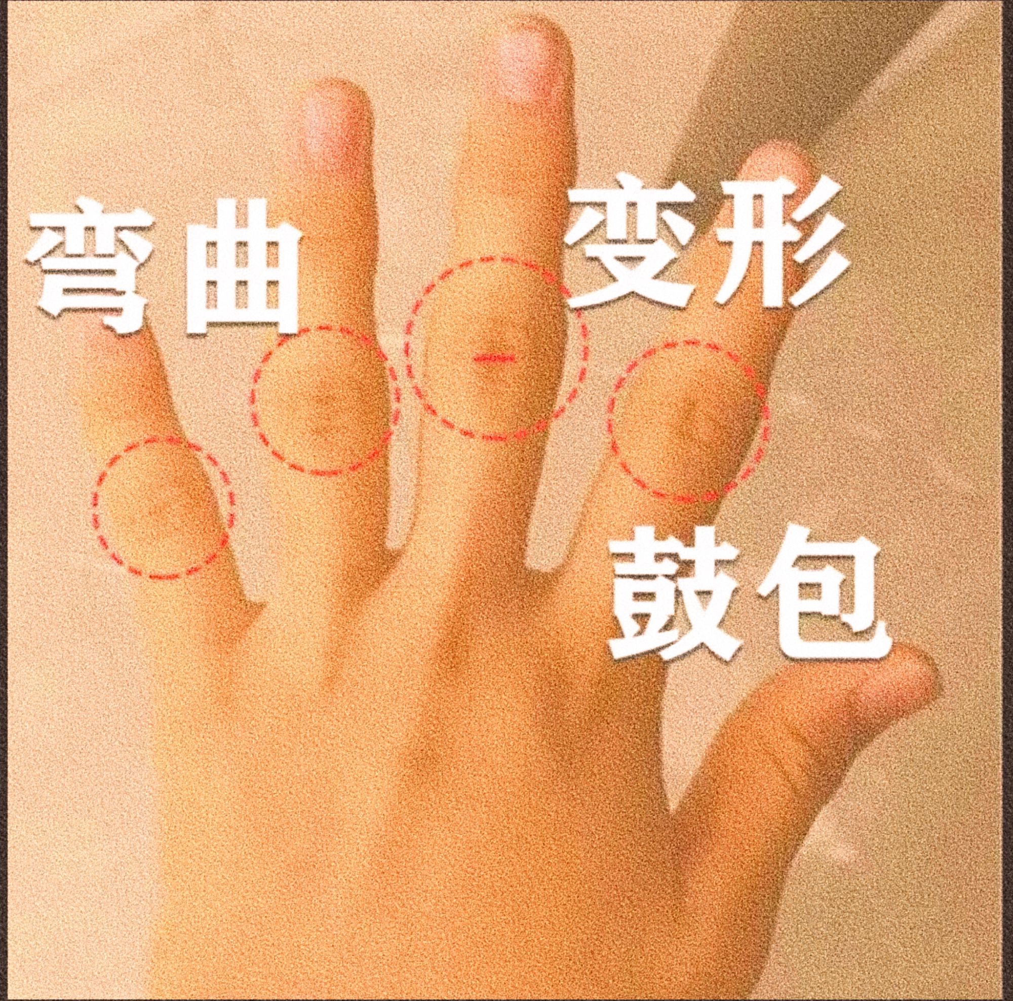 手指骨节粗大变形手指疙瘩鼓包骨指膏