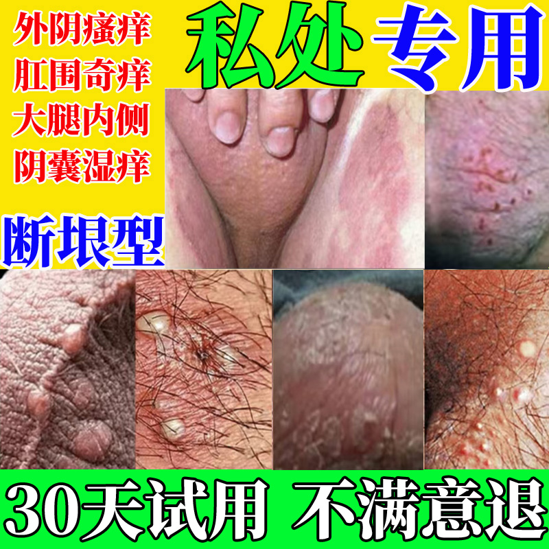 男下体痒红肿长痘起乌龟皮疙瘩大腿内侧私处瘙痒抑菌止痒外用膏 
