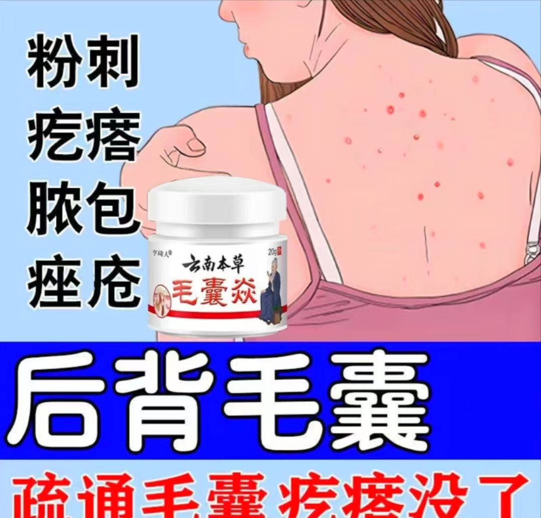 后背毛囊痘痘背上胸前脖子头皮去除止痒专用软膏皮肤抑菌神器