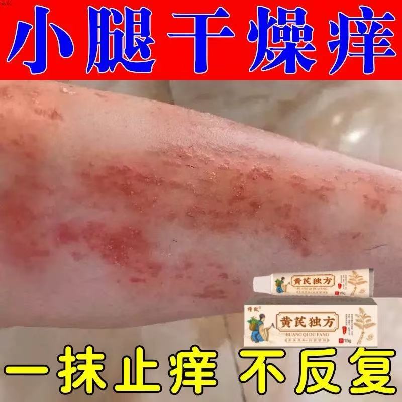 冬天天冷腿痒腿上干燥起皮小腿皮肤起红疙瘩越抓越痒止痒软膏