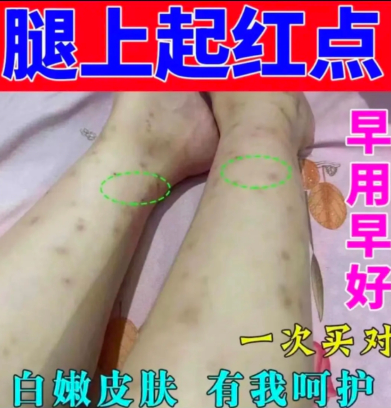 夏季蚊虫叮咬腿上起很多红点点修复咬后留疤脚痒脱皮起水泡喷雾剂