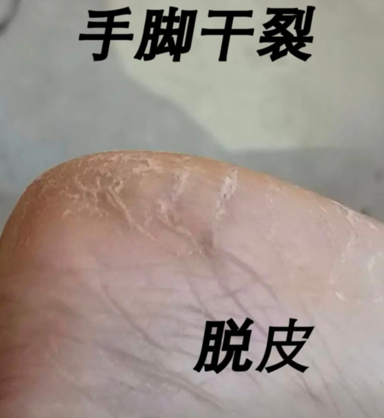 脚脱皮去真菌皮肤干裂脱皮脚干燥开裂脱皮脚后跟增厚硬化干裂