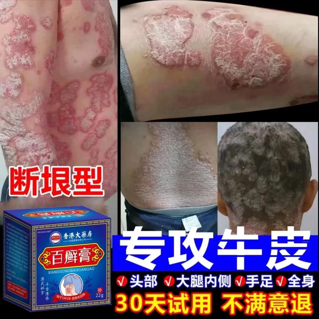 【香港牛皮膏】全身牛/皮/银/屑/鲜手足头体股大腿内侧草本止痒膏