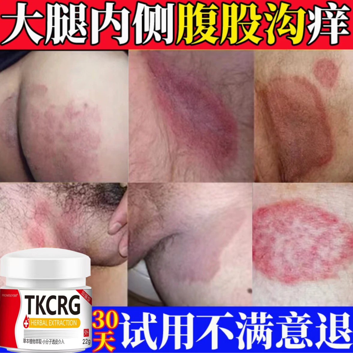 大腿内侧真菌止痒膏男下大腿体痒腹股沟痒特效止痒草本舒缓正品