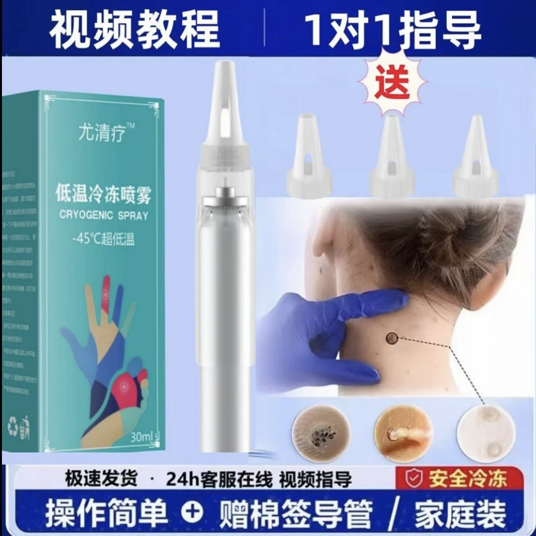 液氮冷冻喷雾低温喷雾喷雾丝状寻常扁平跖