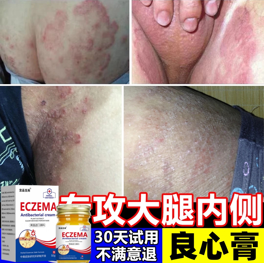 【一款很牛的湿痒膏】皮肤瘙痒干痒大腿内侧痒草本外用快速止痒乳膏