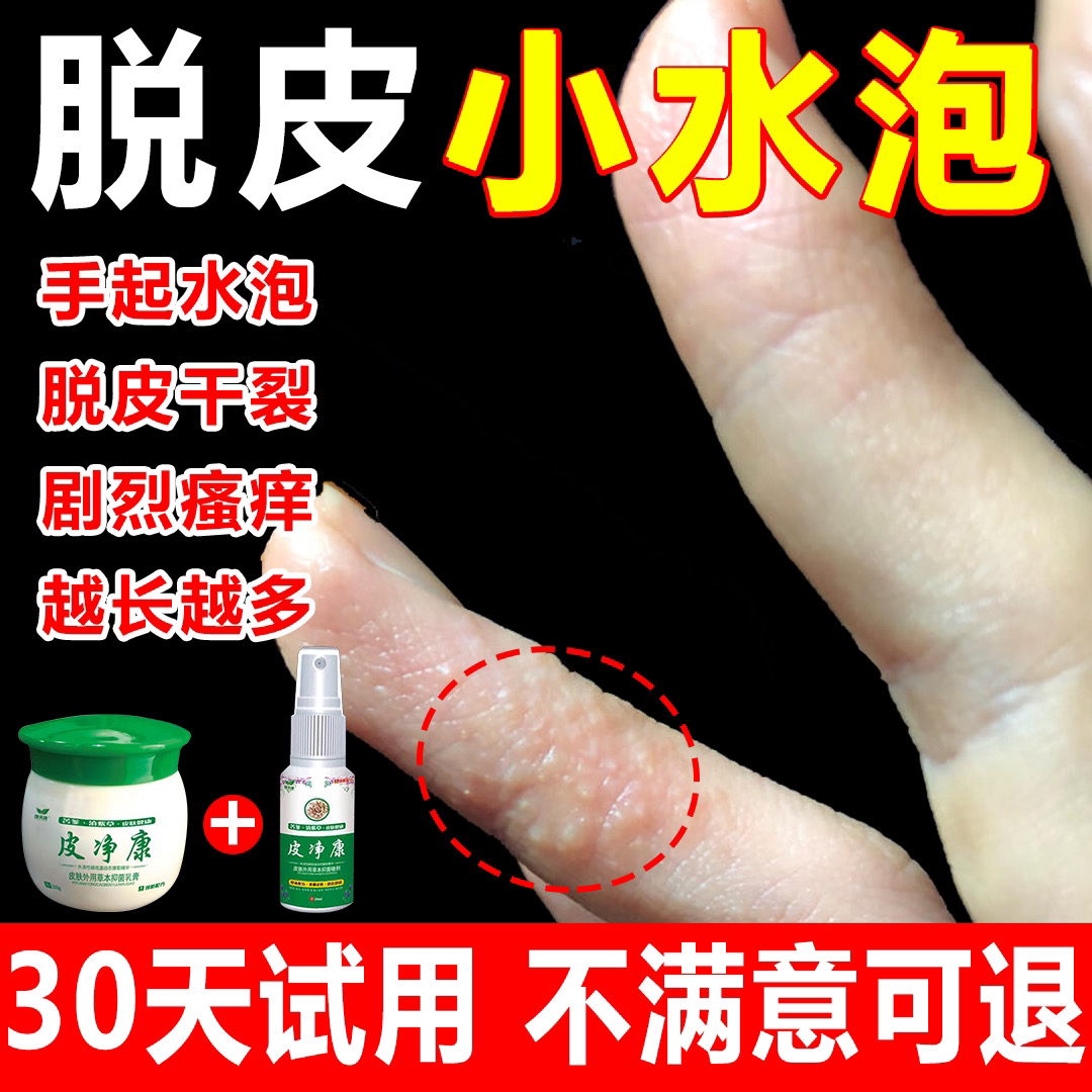 手指痒起水泡痒止痒膏脱皮干裂手掌开裂克星抑菌喷雾剂专用正品特