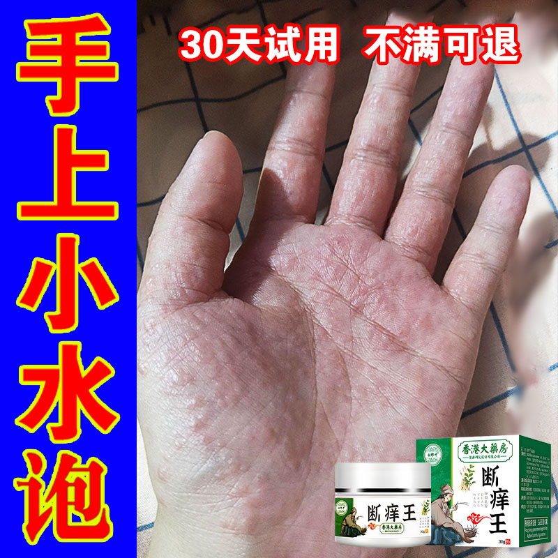 手指红点疙瘩小水包手缝脱皮痒手掌皮肤外用止痒草本萃取断痒王