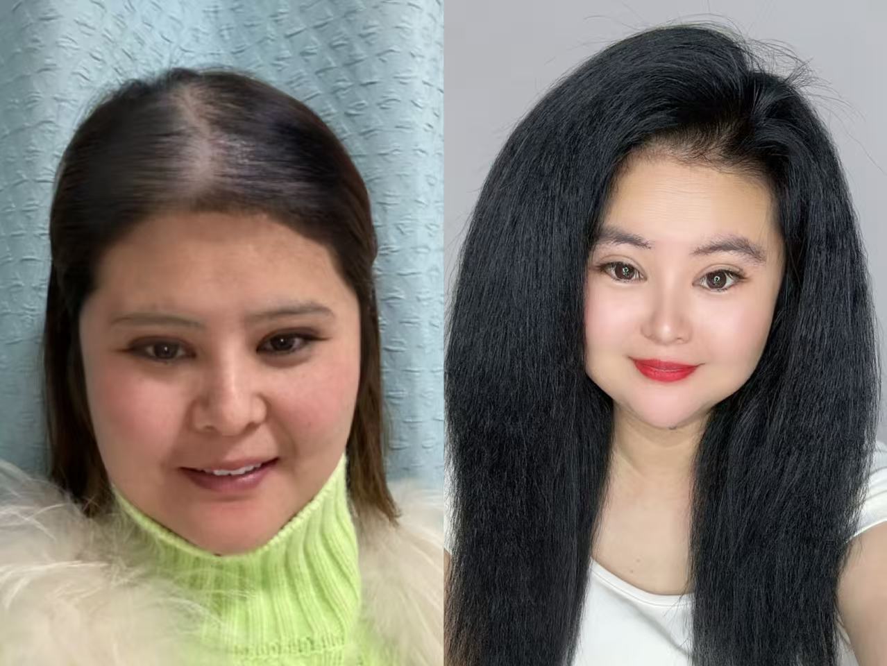 主播养发一年对比 微针