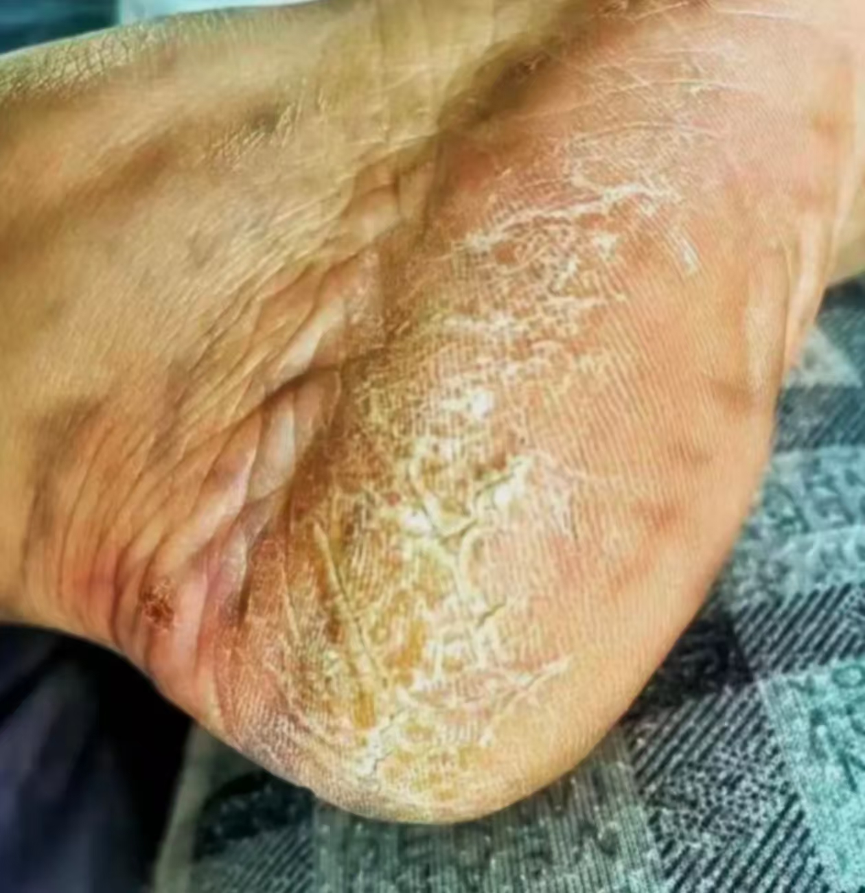 脚底脱皮掉皮起泡痒脚后跟起干皮蜕皮长泡痒脚底起皮烂脚软膏