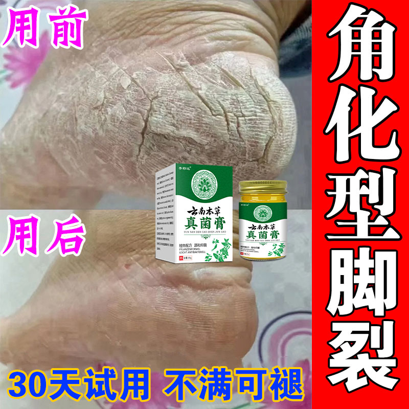 脚 上足后跟干燥开裂秋冬季神器防裂手足干裂手足痒抑菌止痒膏