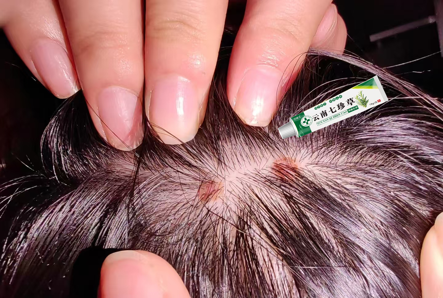 头皮屑多头藓头皮痒头皮毛囊起小红疙瘩脓包除虱子头虱结痂修复膏