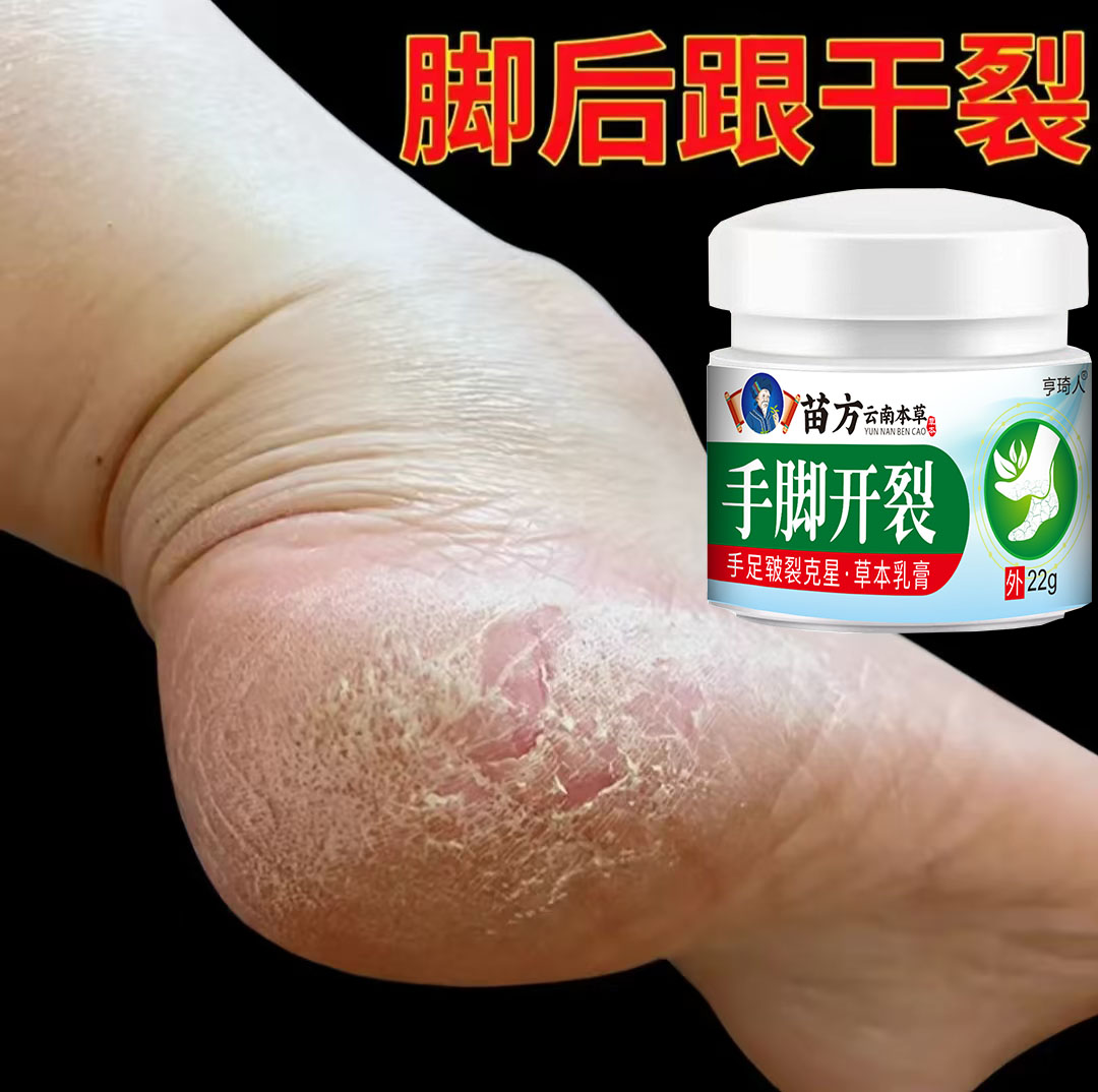 脚后跟干裂粗糙脚底起皮脚痒脚后跟脱皮脚臭抑菌止痒软膏