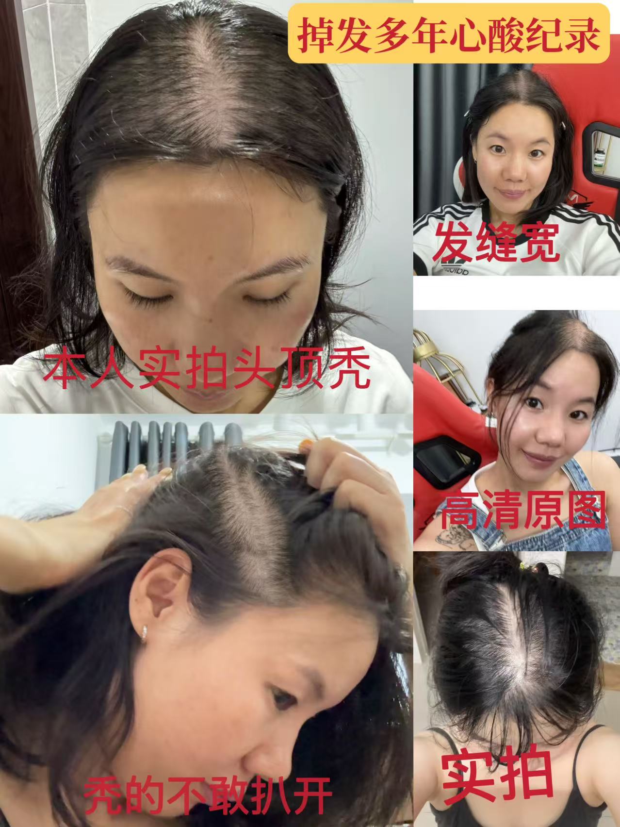 【头发真实对比 主播以前的照片】 头皮上液器 