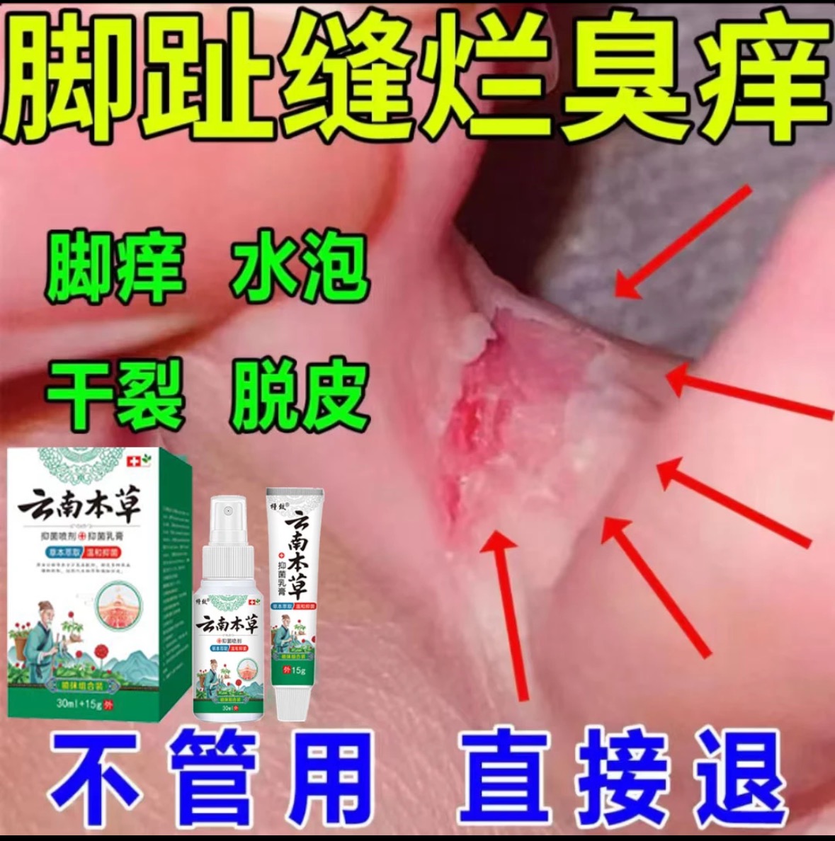 脚趾缝烂臭痒专用止痒膏脚脱皮水泡抑菌止痒神器足部正品草本套装