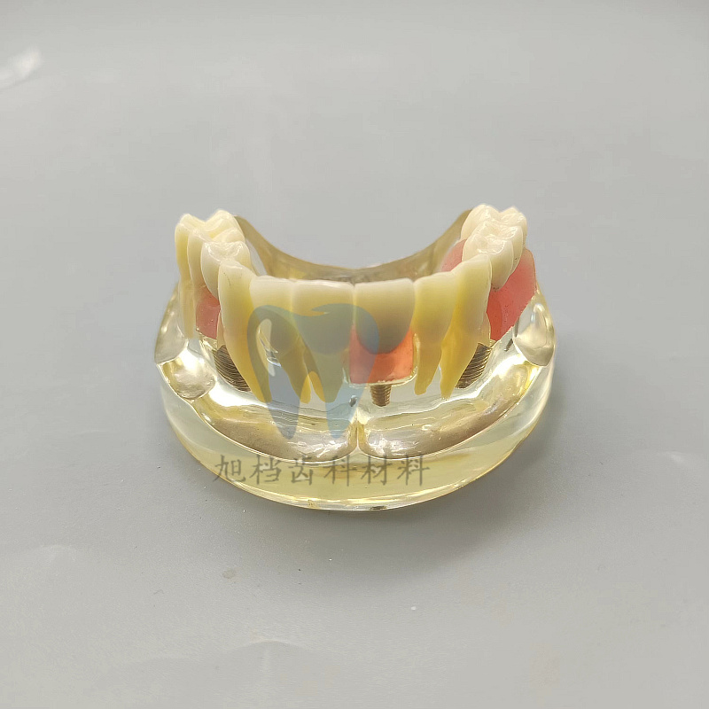 教具口腔教学可拆卸种植2005种植体修复病理模型活动医患沟通包邮