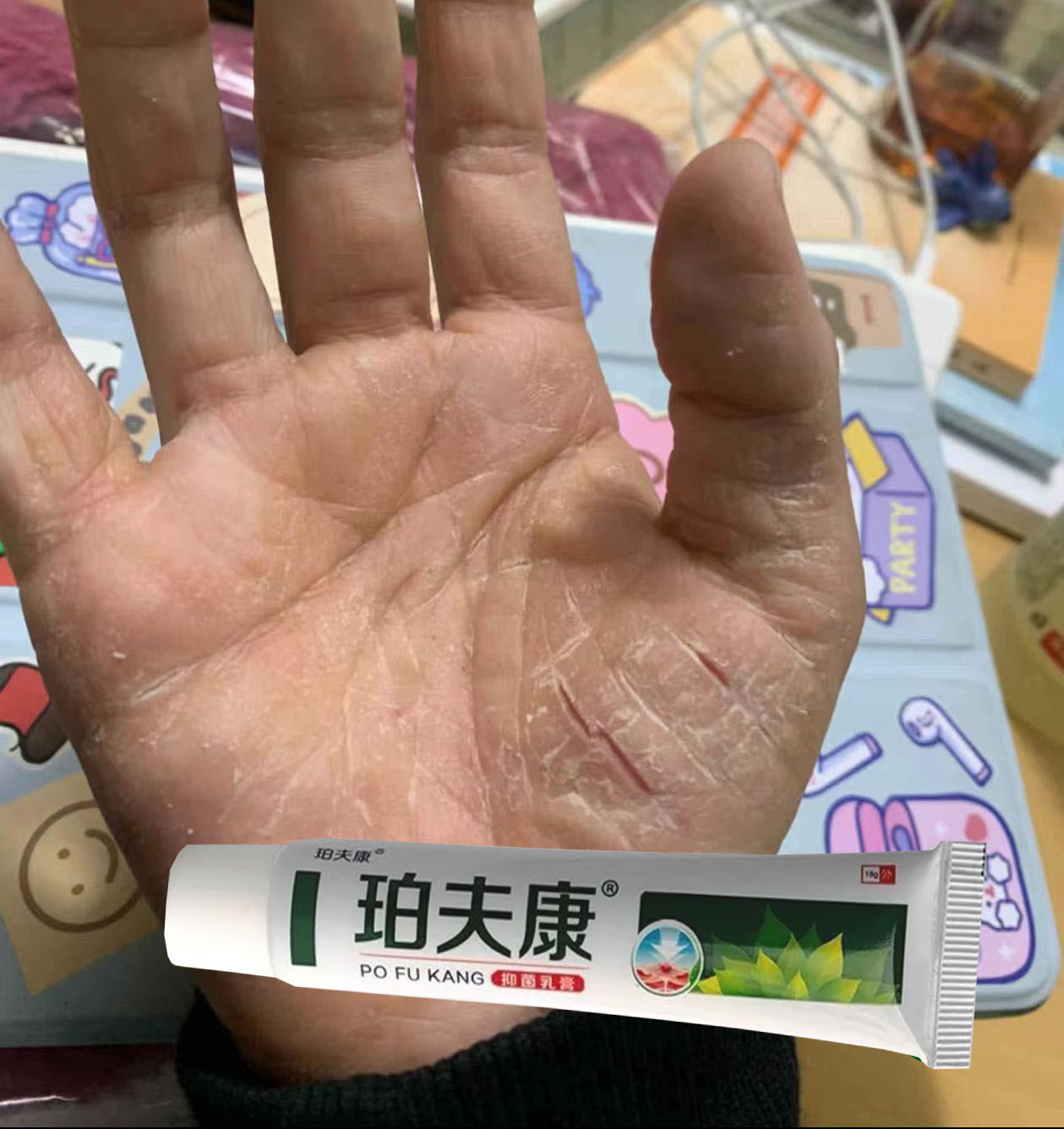 手脚开裂干燥粗糙止痒鹅脱皮掌风干裂防裂霜修复手指痒起硬皮乳膏
