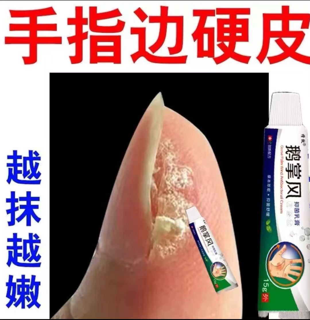 手指边缘起硬皮软化手指两侧死皮倒刺干裂脱皮疼痛红肿专用营养油