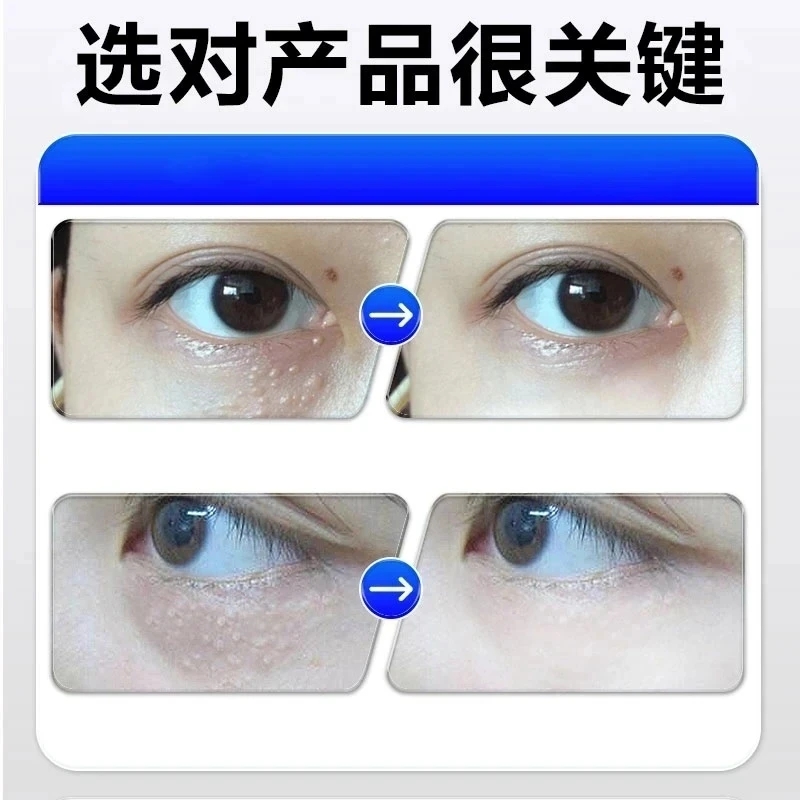 眼部脂肪颗粒眼周汗管油脂粒黑眼圈男女通用眼霜草本乳膏