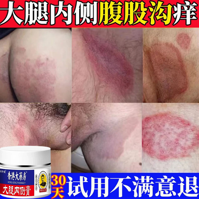 大腿内侧真菌止痒膏男下大腿体痒腹股沟痒止痒草本舒缓正品