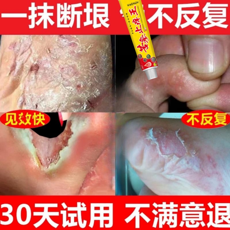 脚痒脚汗脚底脚上起小水痒泡脱皮脚臭气止痒草本抑菌软膏神器克星