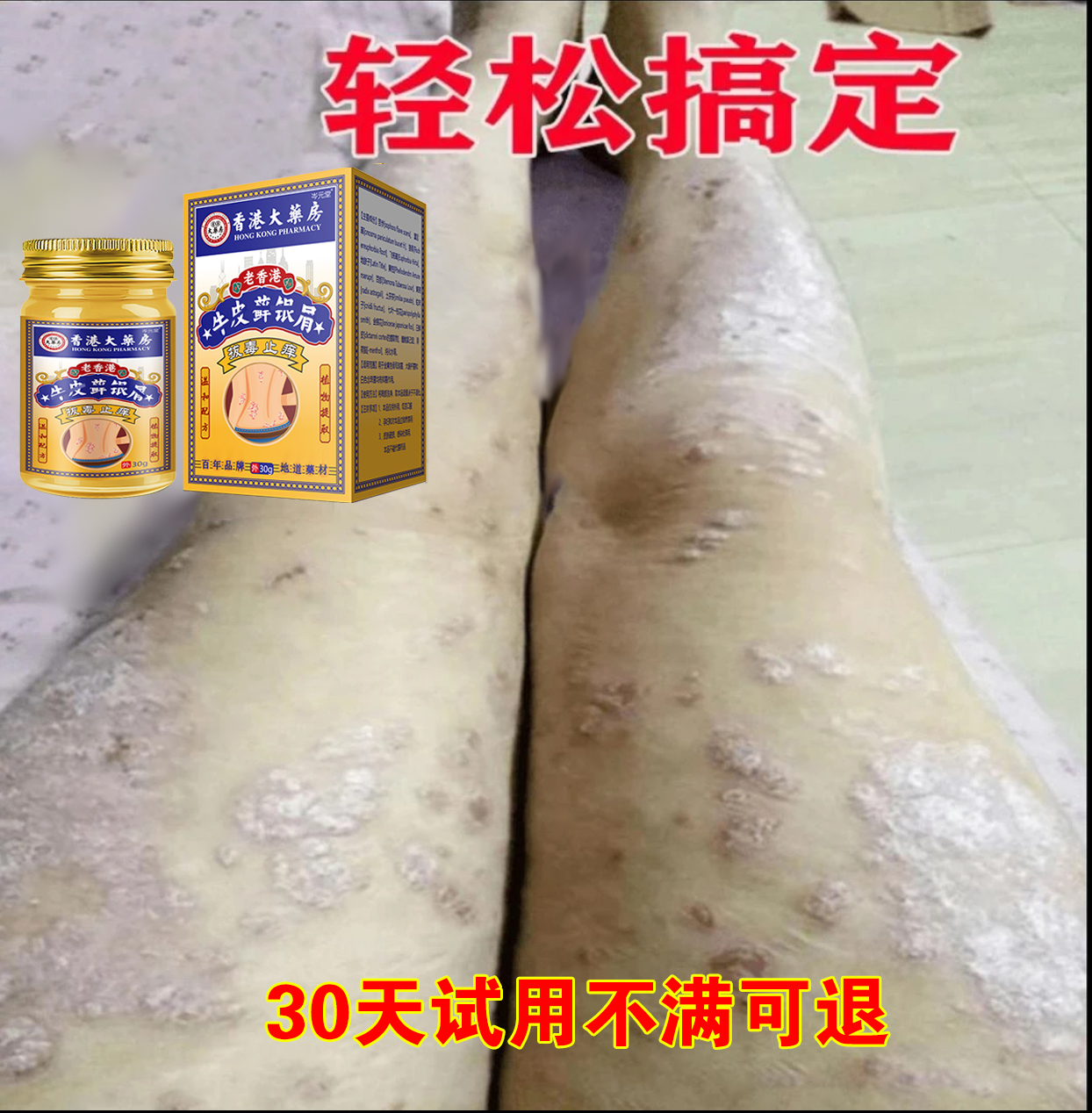【牛藓克星】全身白屑皮肤止痒红点顽固手足体股香港大楽房草本乳膏