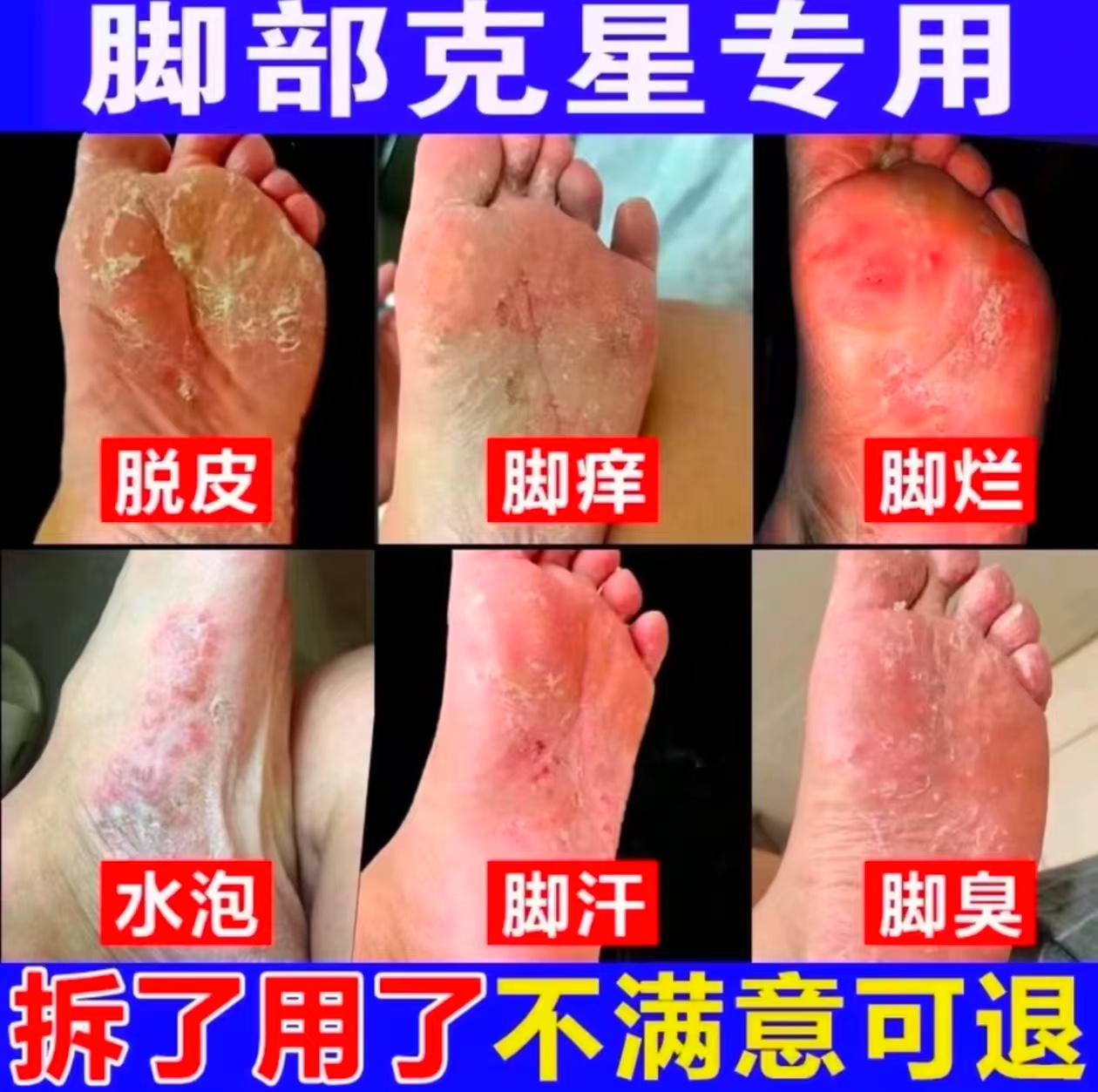 【脚部克星】脚趾缝臭痒专用脚痒脚臭止痒神器脚丫脱皮抑菌喷雾剂