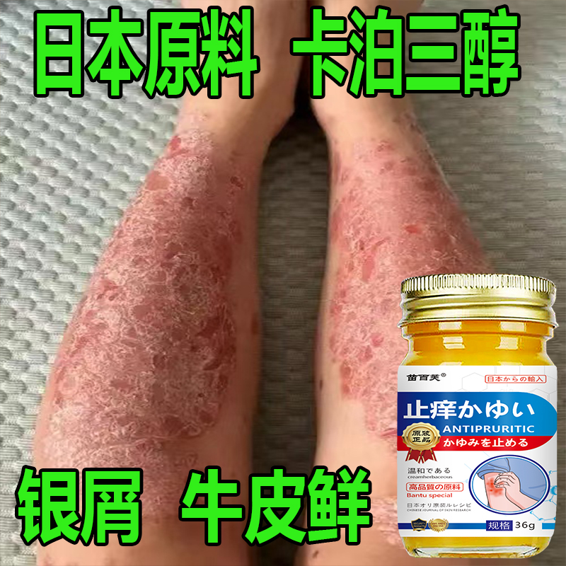 牛皮专用银屑顽鲜卡泊三淳倍他米软膏手足体股头鲜全身草本止痒膏
