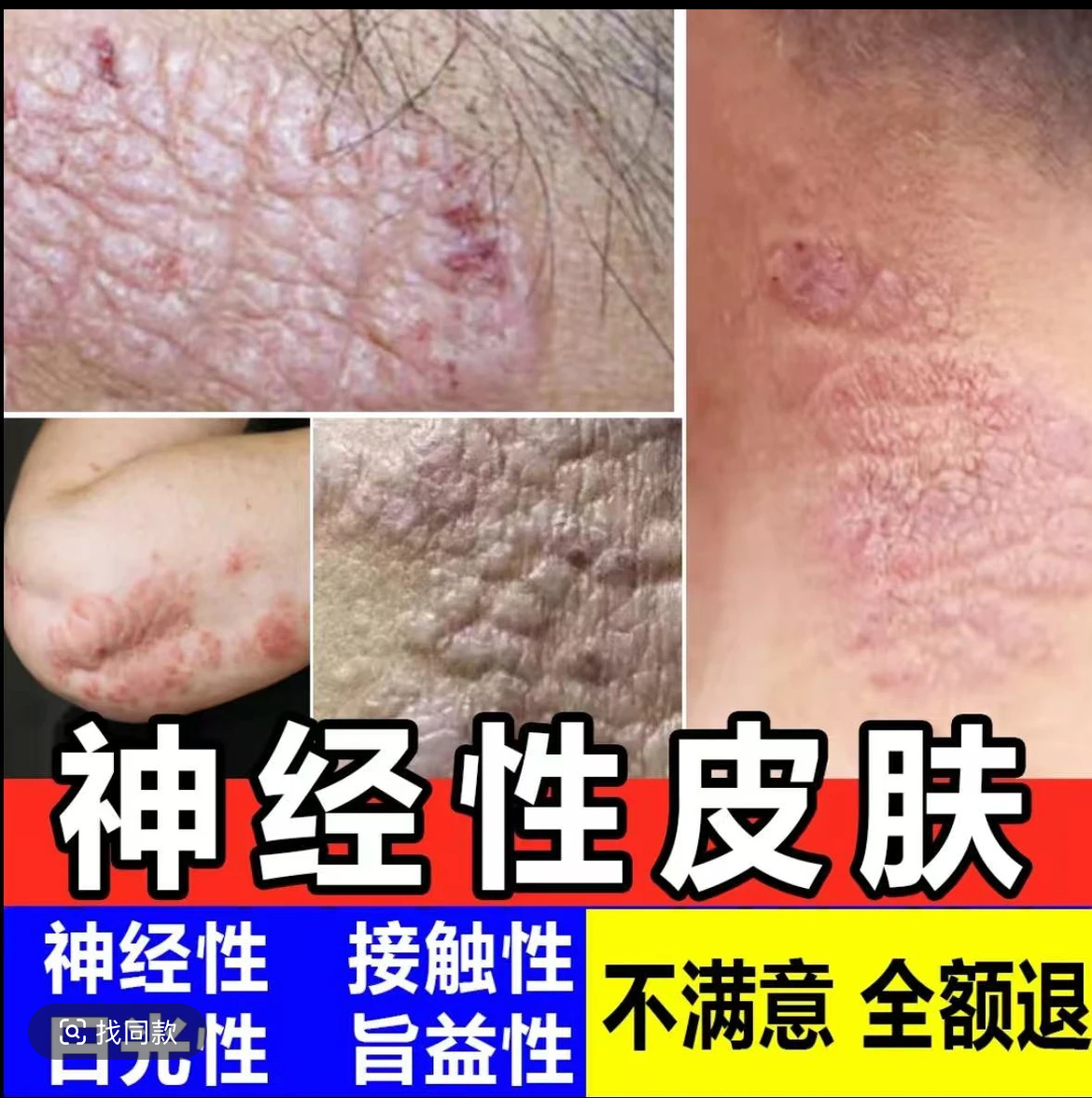 神经性皮肤止痒膏顽固皮手足湿痒抑菌乳膏特效草本修复克星正品