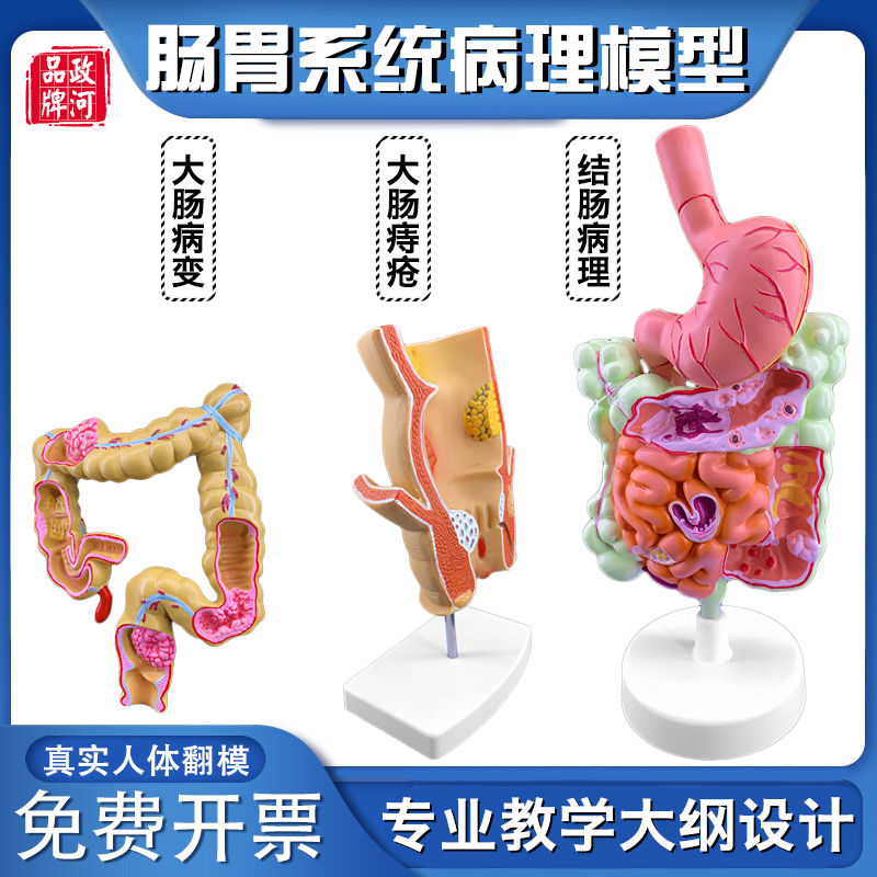 大肠病理模型大肠模型 肠 消化道疾病人体结肠直肠痔新疆西藏专链