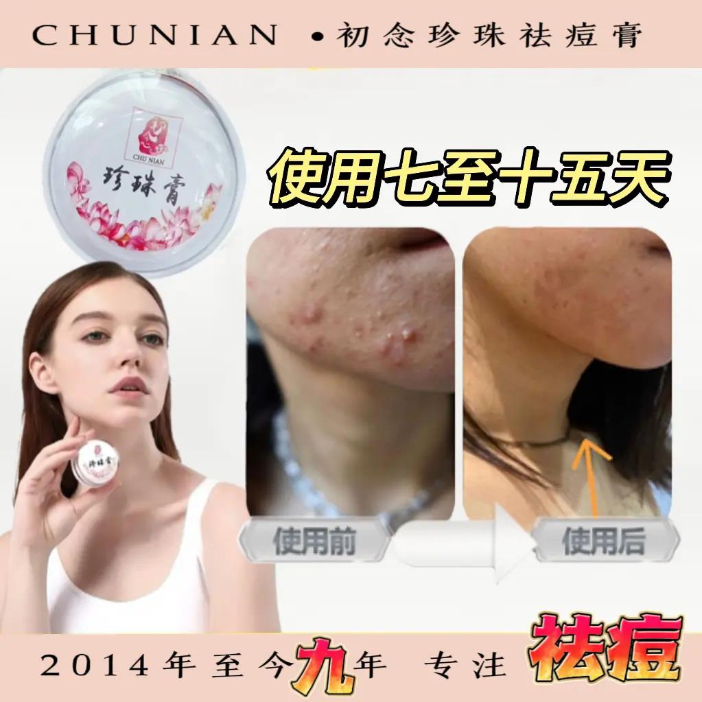 初念九年品牌产品祛痘珍珠膏祛痘膏面霜珍珠学生祛痘痘印淡化痘印